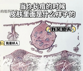 皮肤爆痘留印又留坑的真相